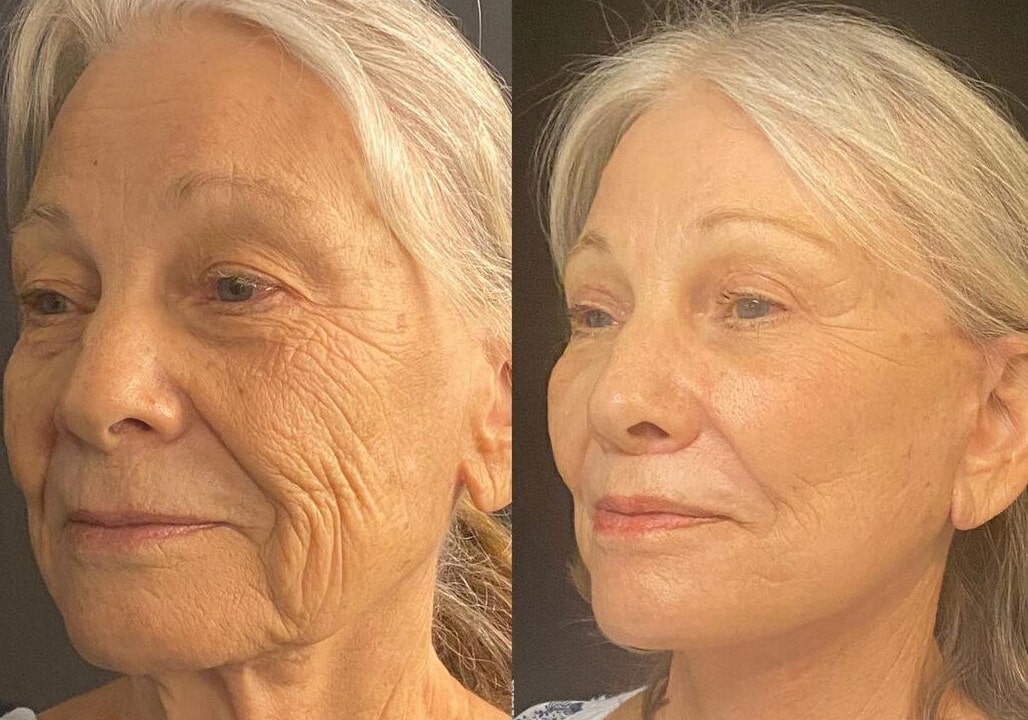 Facelift before and after