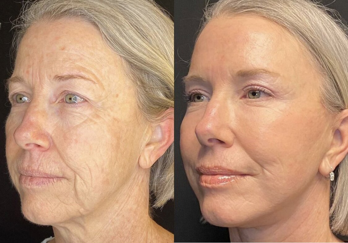 Facelift before and after