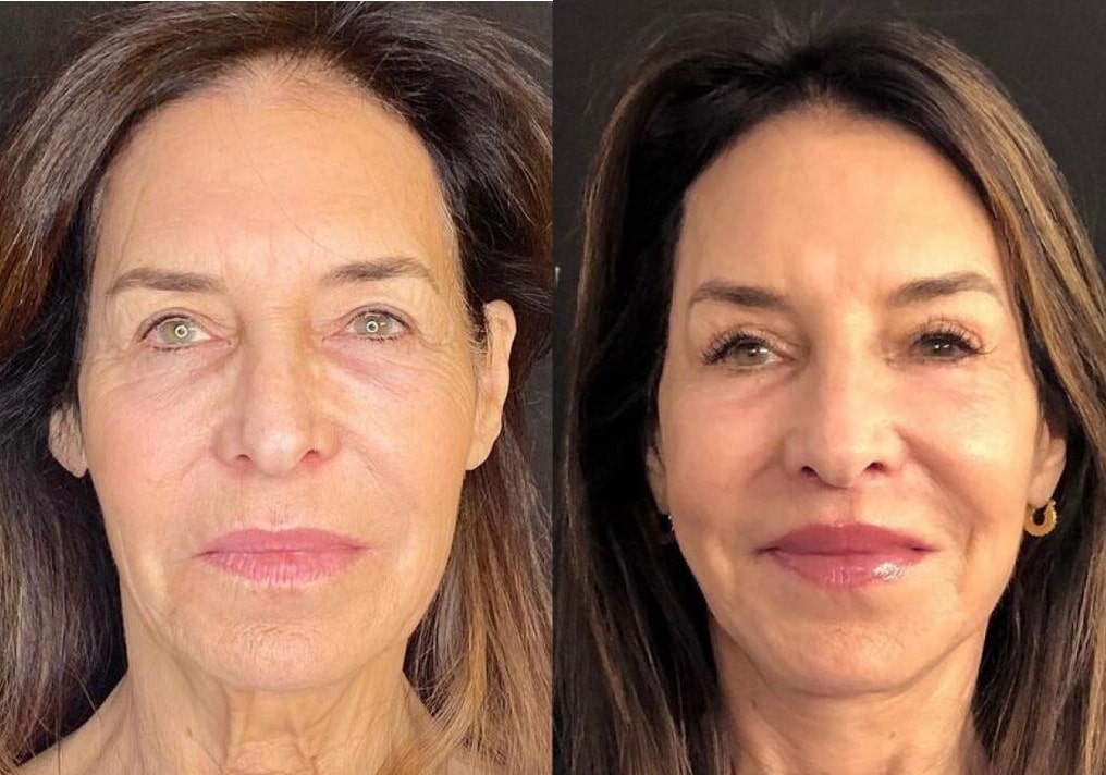 Facelift before and after