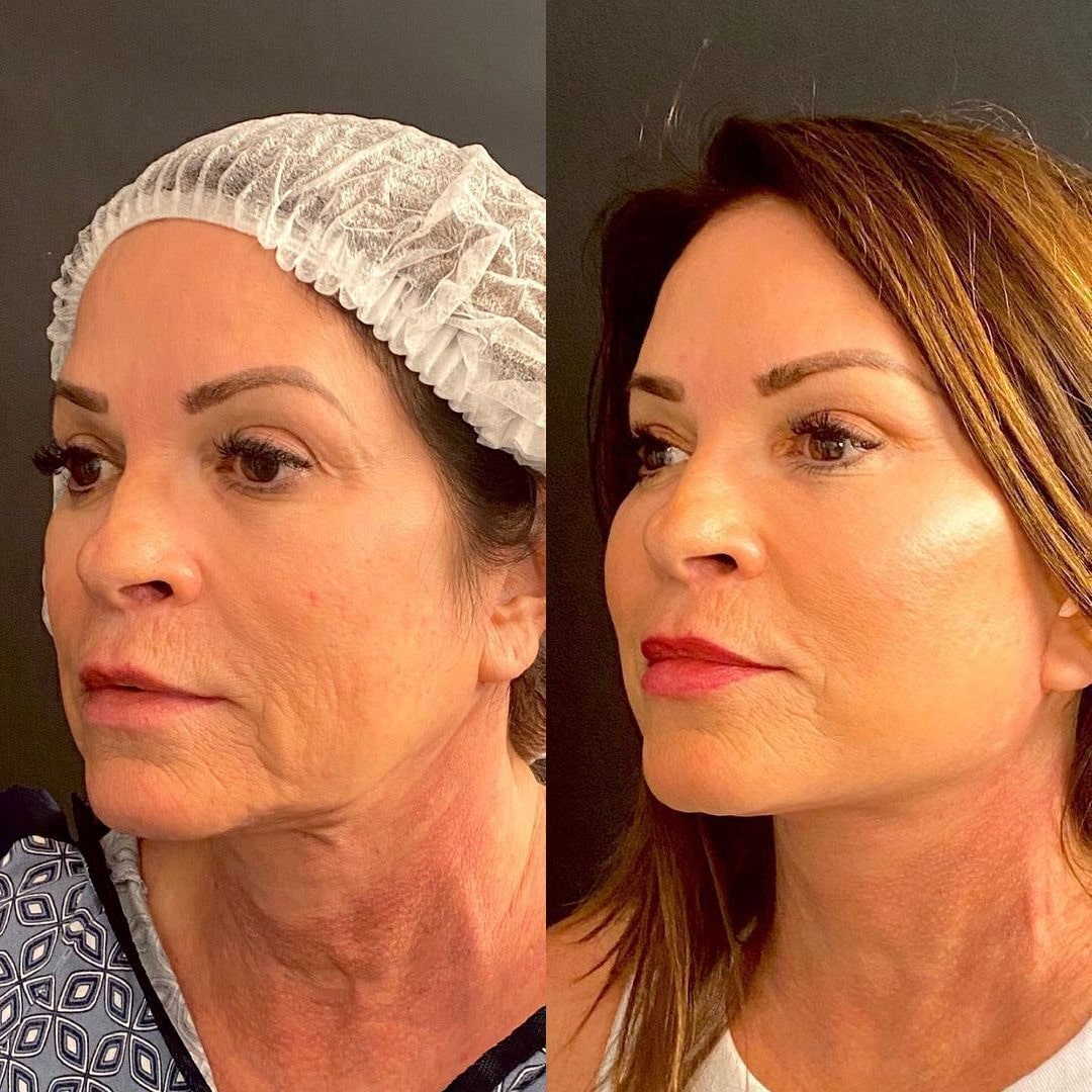 Facelift before and after