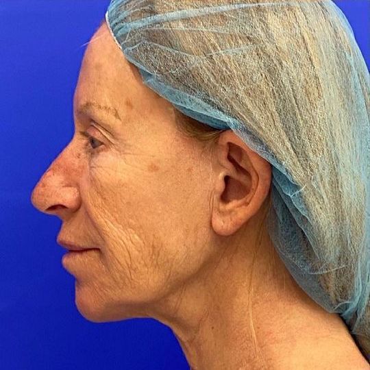 Deep Plane Facelift Before & After Image