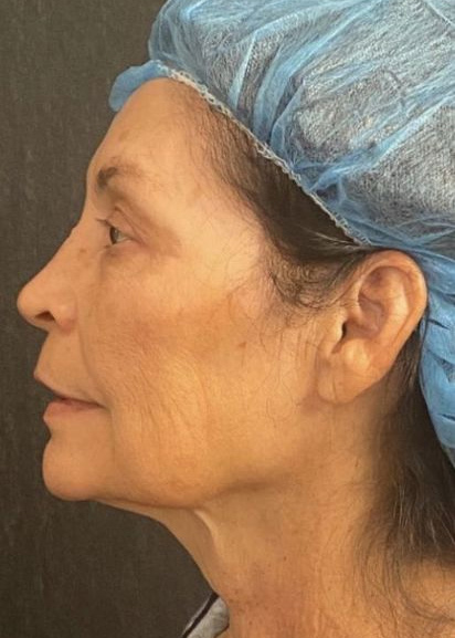 Deep Plane Facelift Before & After Image