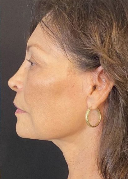 Deep Plane Facelift Before & After Image