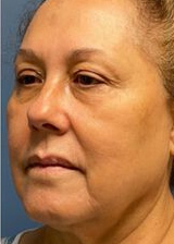 Deep Plane Facelift Before & After Image