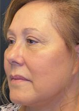 Deep Plane Facelift Before & After Image