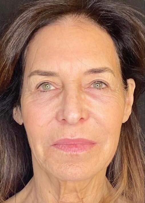 Deep Plane Facelift Before & After Image