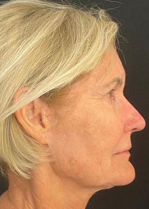 Deep Plane Facelift Before & After Image