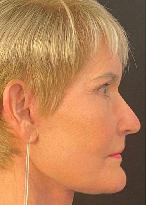 Deep Plane Facelift Before & After Image