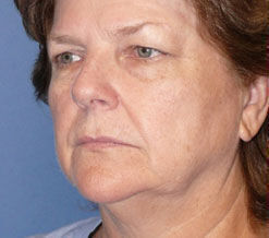 Facelift Before & After Image