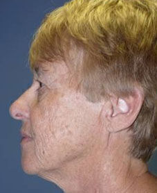 Facelift Before & After Image