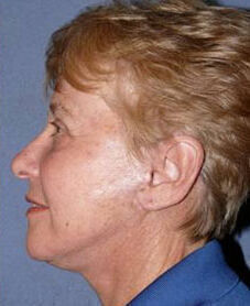 Facelift Before & After Image