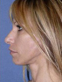 Facelift Before & After Image