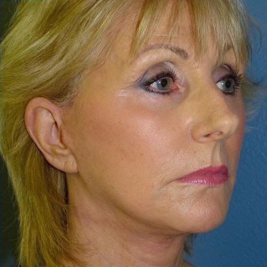 Facelift Before & After Image