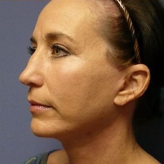 Facelift Before & After Image