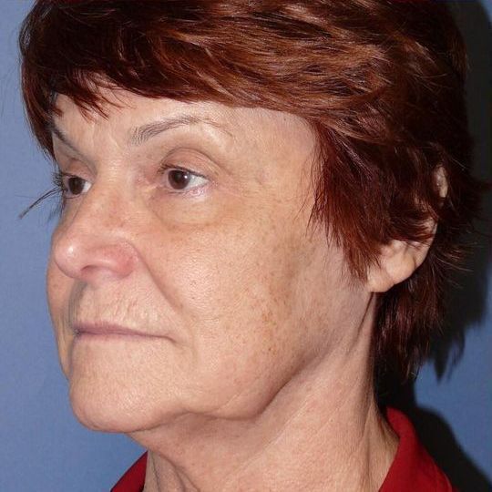 Facelift Before & After Image