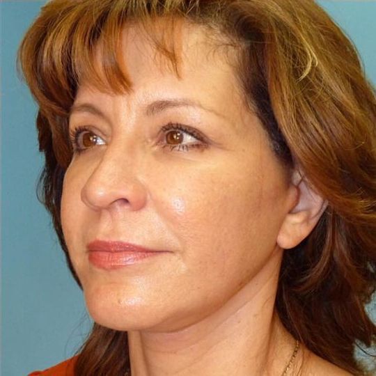 Facelift Before & After Image