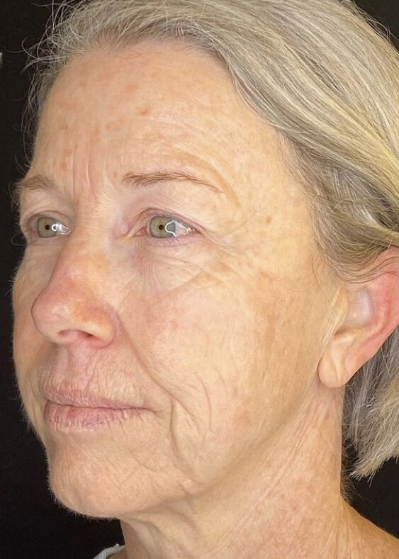 Facelift Before & After Image