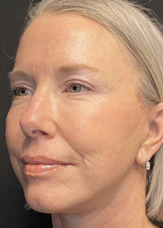 Facelift Before & After Image