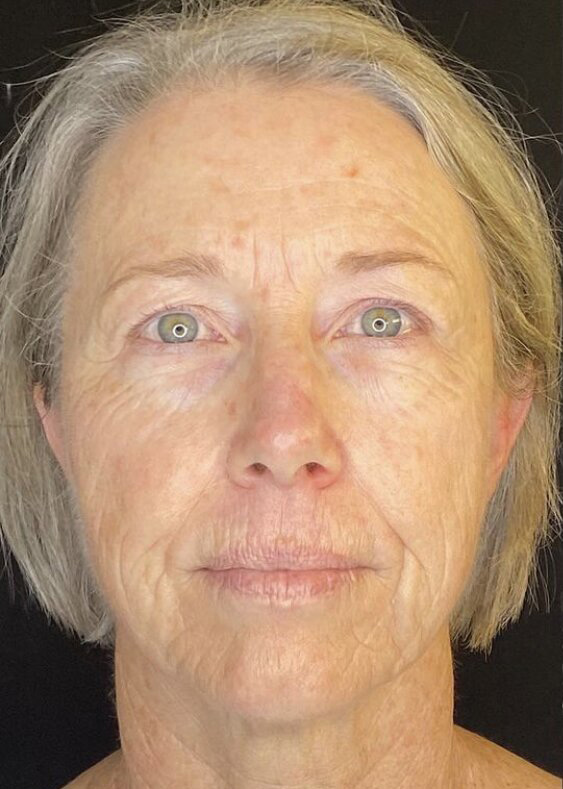 Facelift Before & After Image