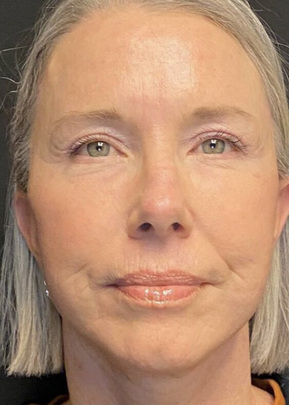 Facelift Before & After Image